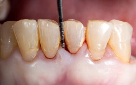 Well Leite - Periodontia.