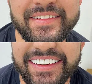 Well Leite - Facetas em Resina.